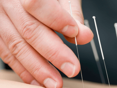 colocação de agulha de acupuntura